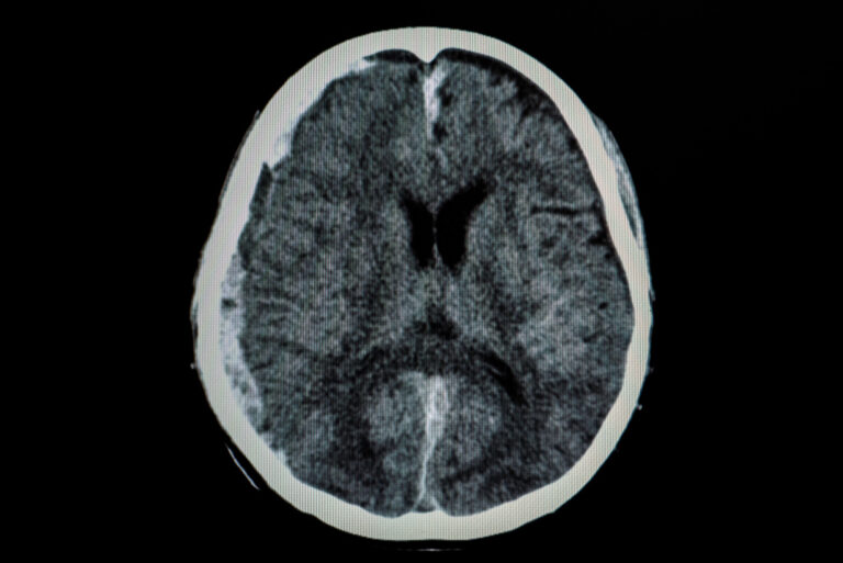 tbi and va disability