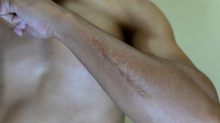 VA scarring